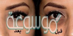ما هي اسباب الهالات السوداء تحت العينين وما طرق علاجها