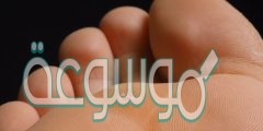 كيفية علاج مسمار القدم بالأعشاب وبطرق طبيعية سريعة 2022