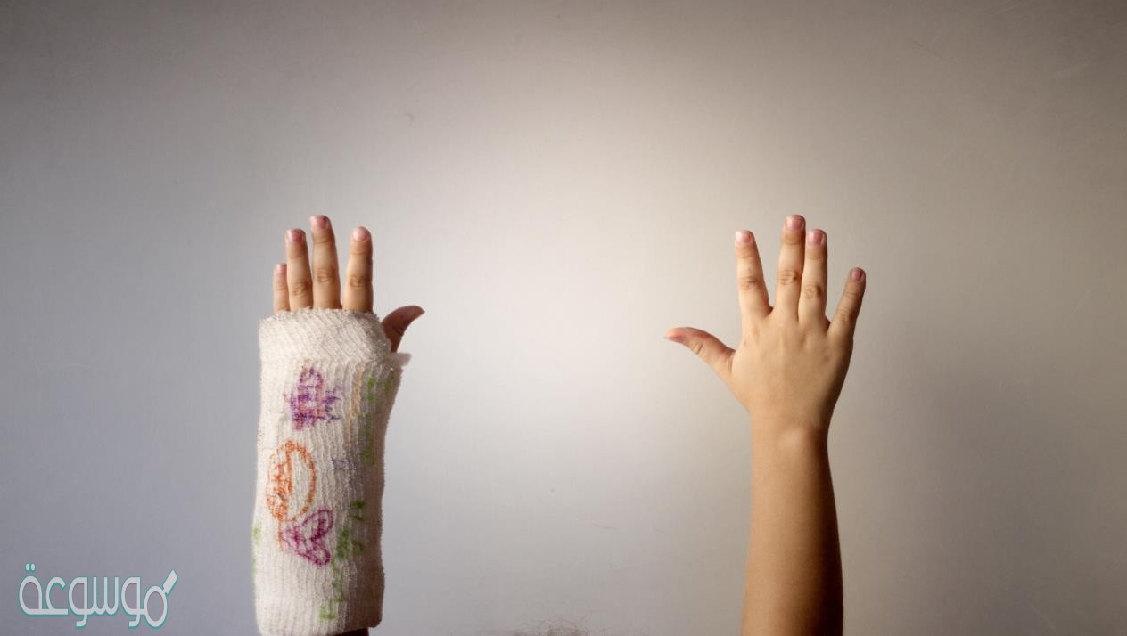 كيف اعرف ان العظم التأم