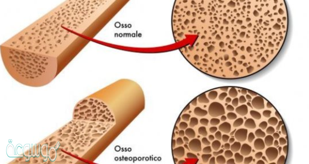 المسامات في العظم الإسفنجي تجعل العظم مرنًا