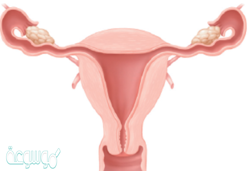 كيس عضلي كمثري الشكل في الانثى