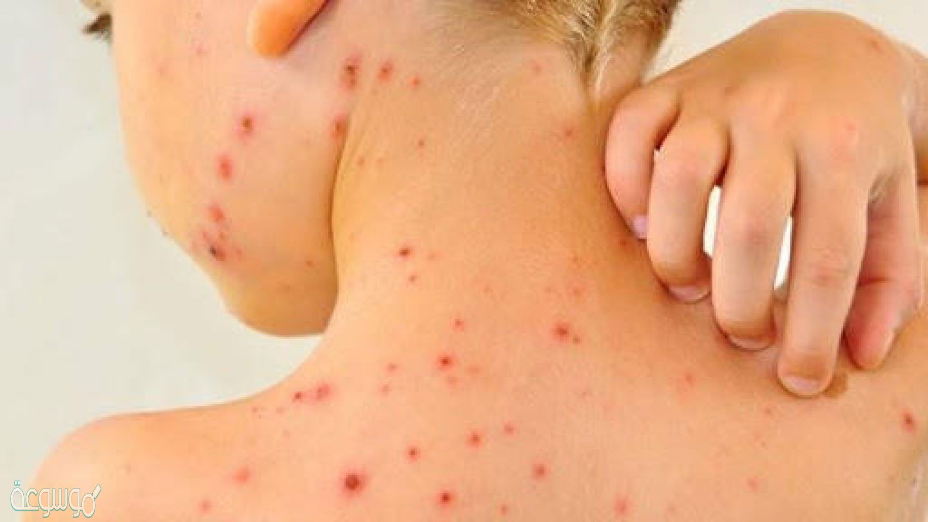 ينتمي فيروس الجدري إلى الفيروسات الارتجاعية