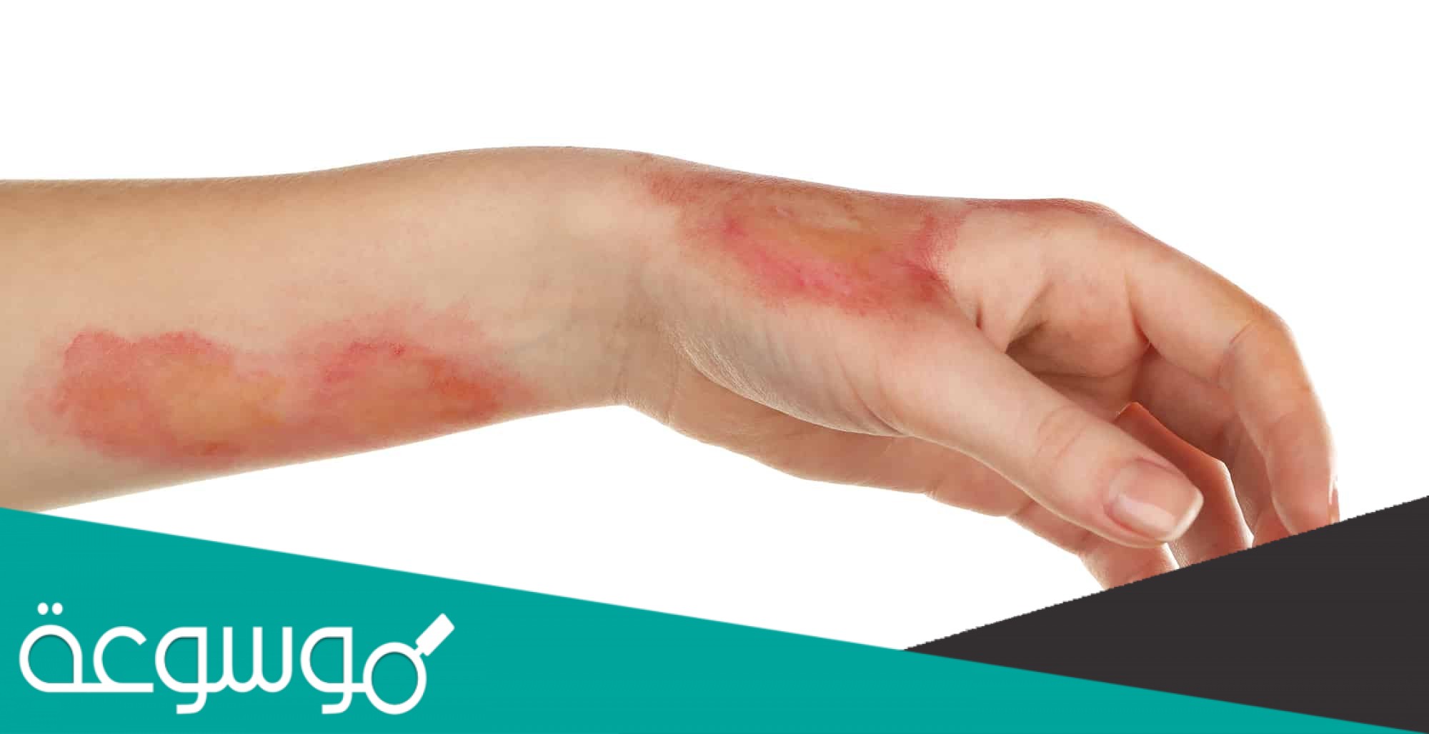 عند التعرض للحروق أو بعض الأمراض التي تسبب ضرر في مساحات كبيرة من الجلد يلجأ الأطباء إلى زراعة الجلد