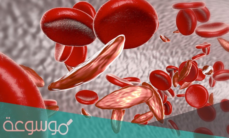 ما هو فقر الدم المنجلي