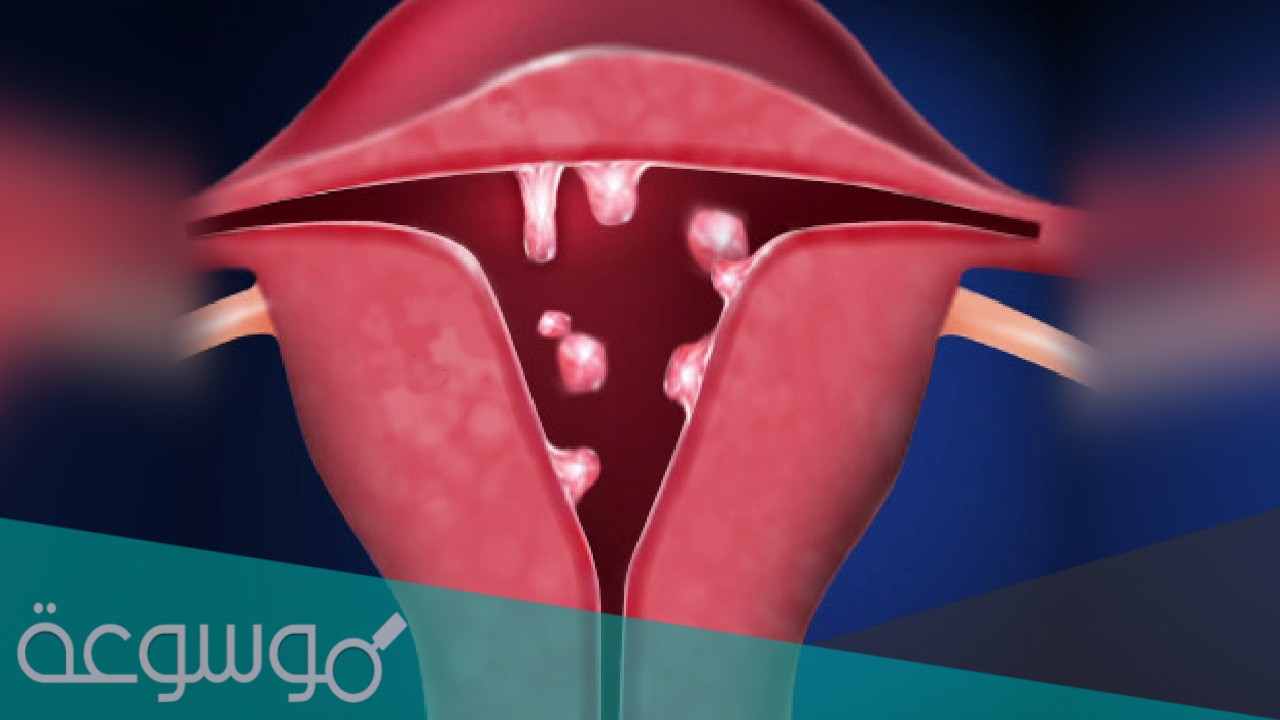 هل يحدث حمل بعد إزالة لحمية الرحم