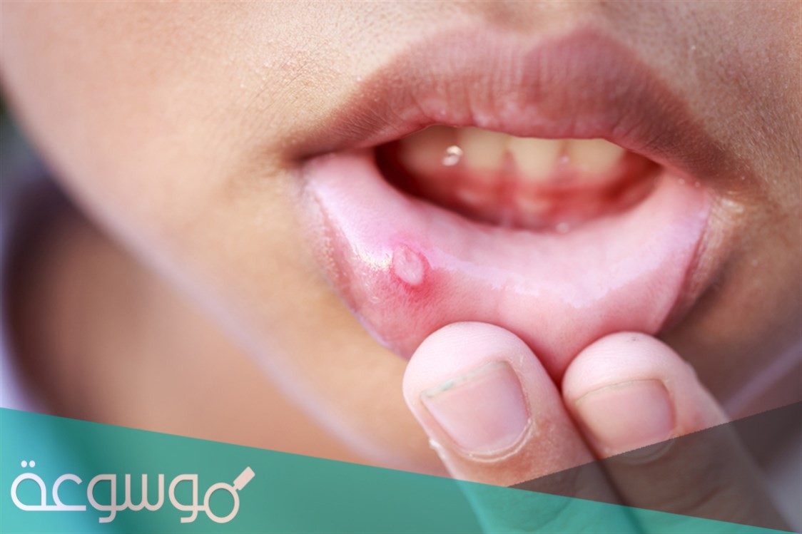 ما أهم علاج فطريات الفم واللسان والطرق البسيطة لذلك