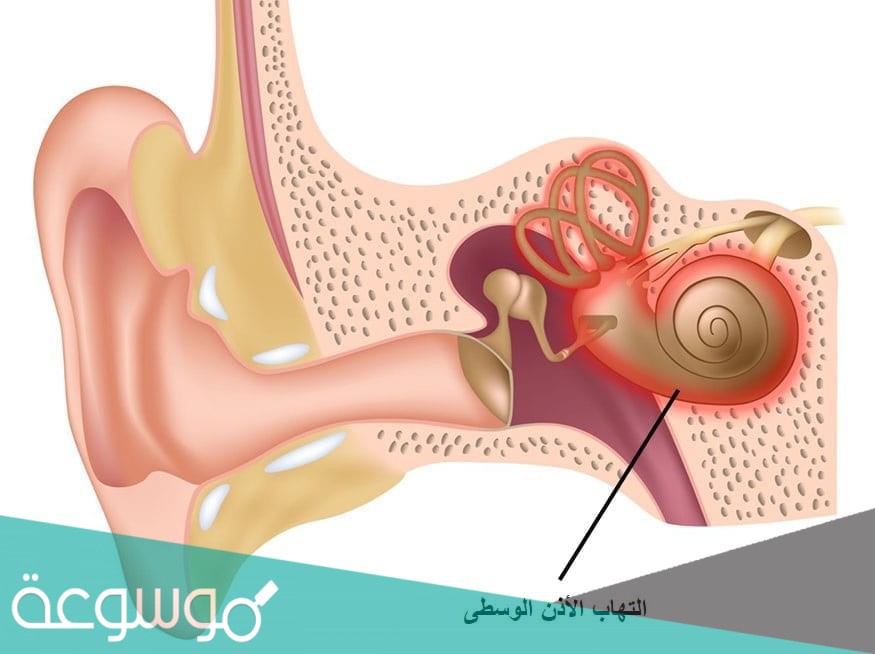 اعراض التهاب الاذن الوسطى عند الكبار