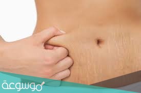 ما هو الاسترتش مارك