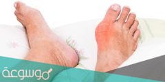 ما هو النقرس وما هي أعراضه وأسبابه ومضاعفاته وكيفية علاجه