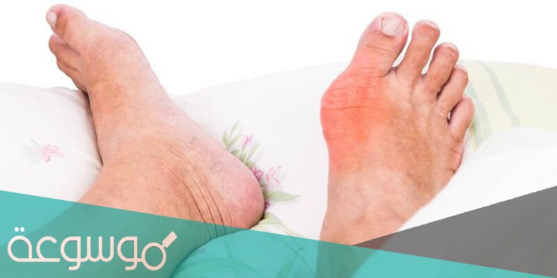 ما هو النقرس