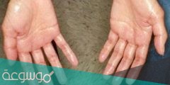 اسباب تعرق اليدين والرجلين وطرق علاج التعرق