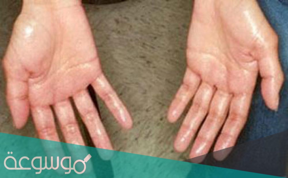 اسباب تعرق اليدين والرجلين وطرق علاج التعرق