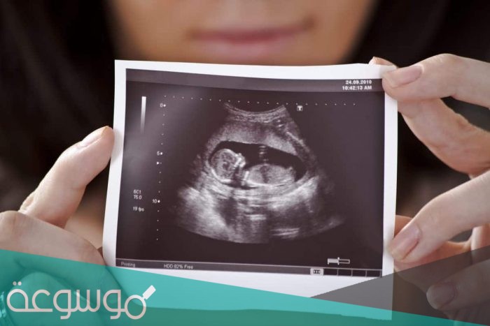 كيف اعرف نوع الجنين من ورقة السونار