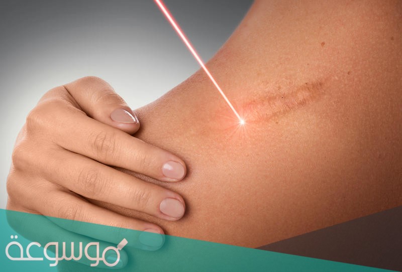 ماذا يسمى اثر الجرح