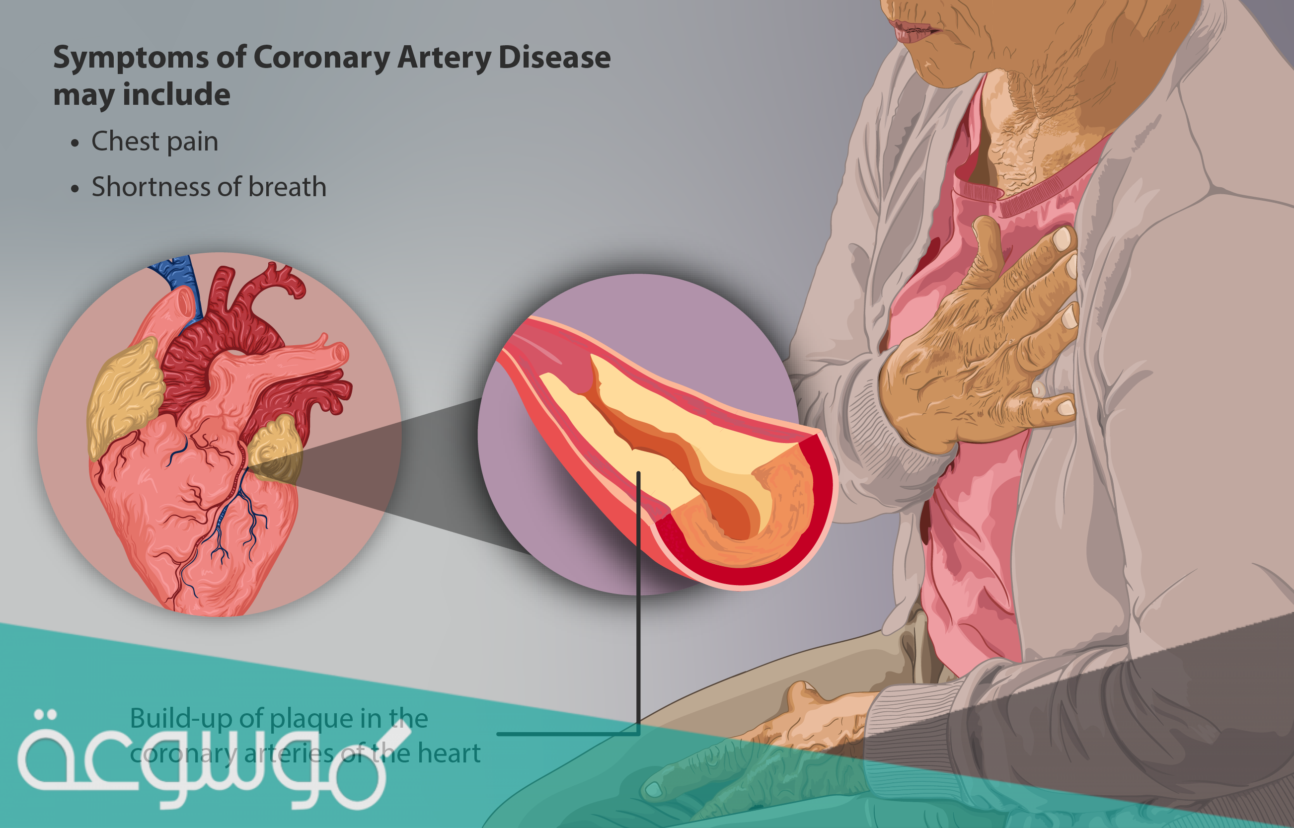 عملية القسطرة