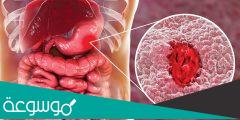 اسباب عودة جرثومة المعدة وطرق علاجها
