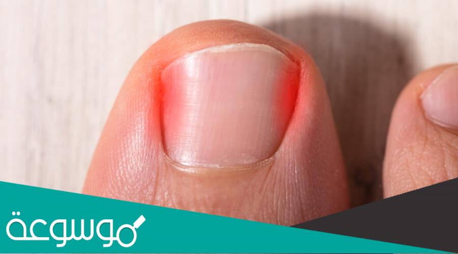 أسباب الأظافر المنغرسة