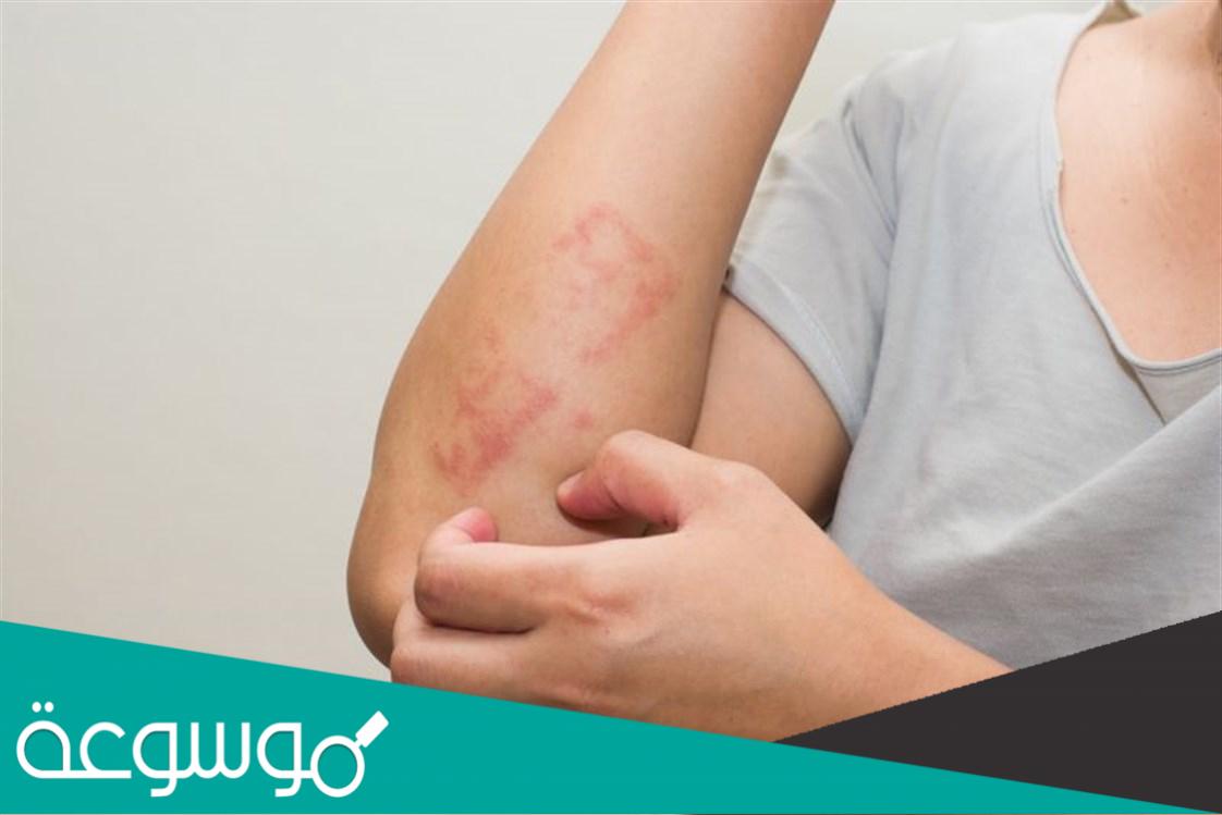 أطعمة مفيدة لمرضى الصدفية