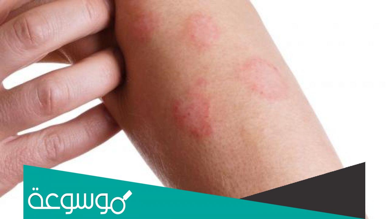 أعراض ومعلومات هامة عن مرض بهجت