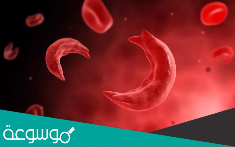 أنواع الأنيميا وأسباب الإصابة بها