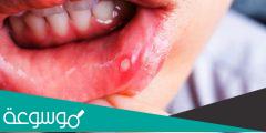 أنواع التهابات الفم وكيفية علاجها