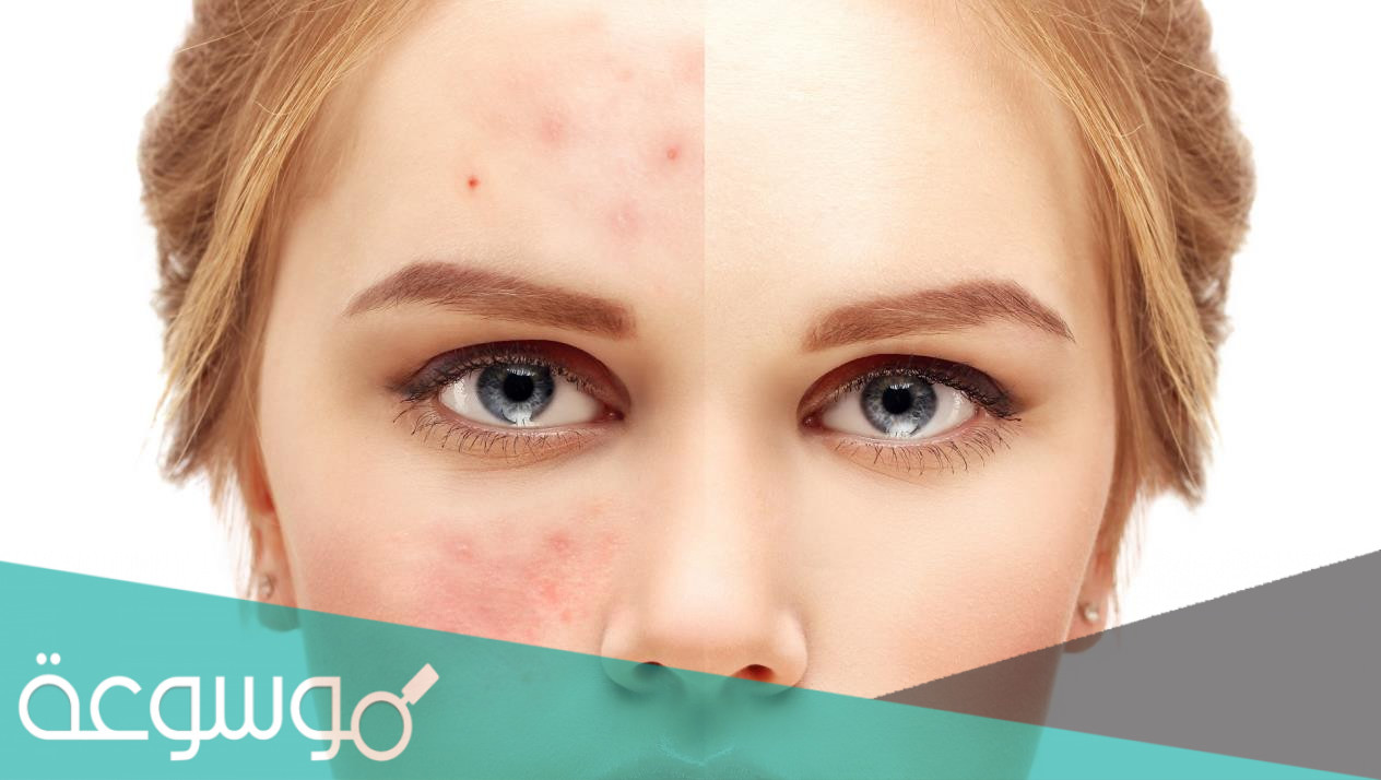 أنواع الحبوب الجلدية