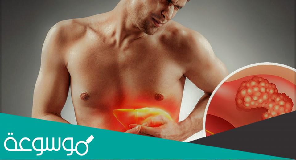 أنواع سرطانات الكبد الأولية و أسباب الإصابة بها