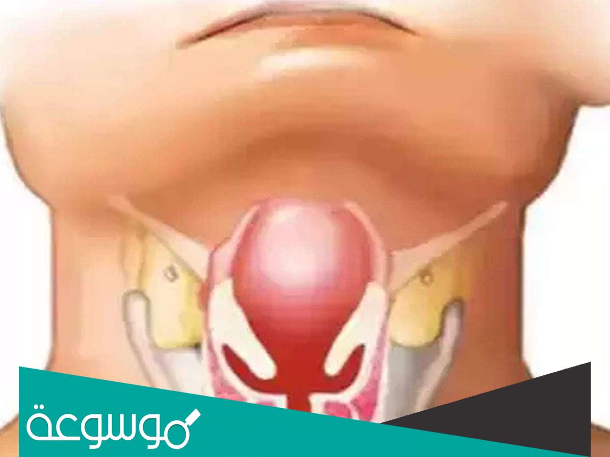 أهم الوصفات المنزلية لعلاج مرض الدفتيريا