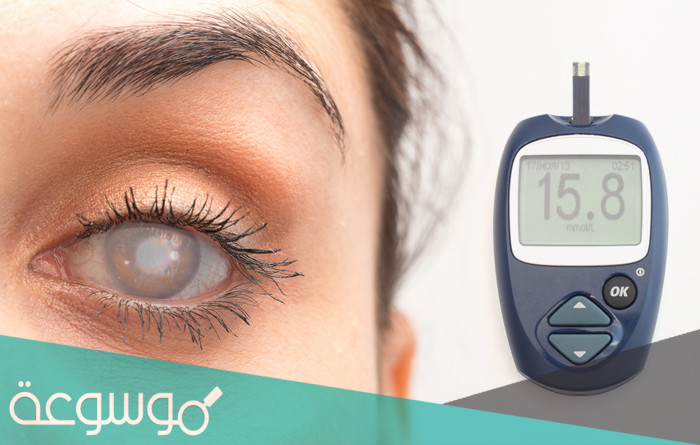 اسباب وعلاج مشاكل العيون عند مرضى السكر