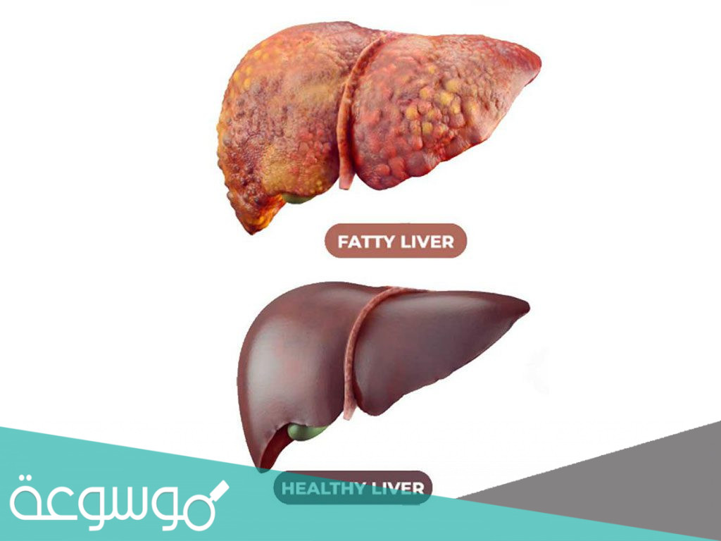 الفيتامينات التي تقاوم دهون الكبد