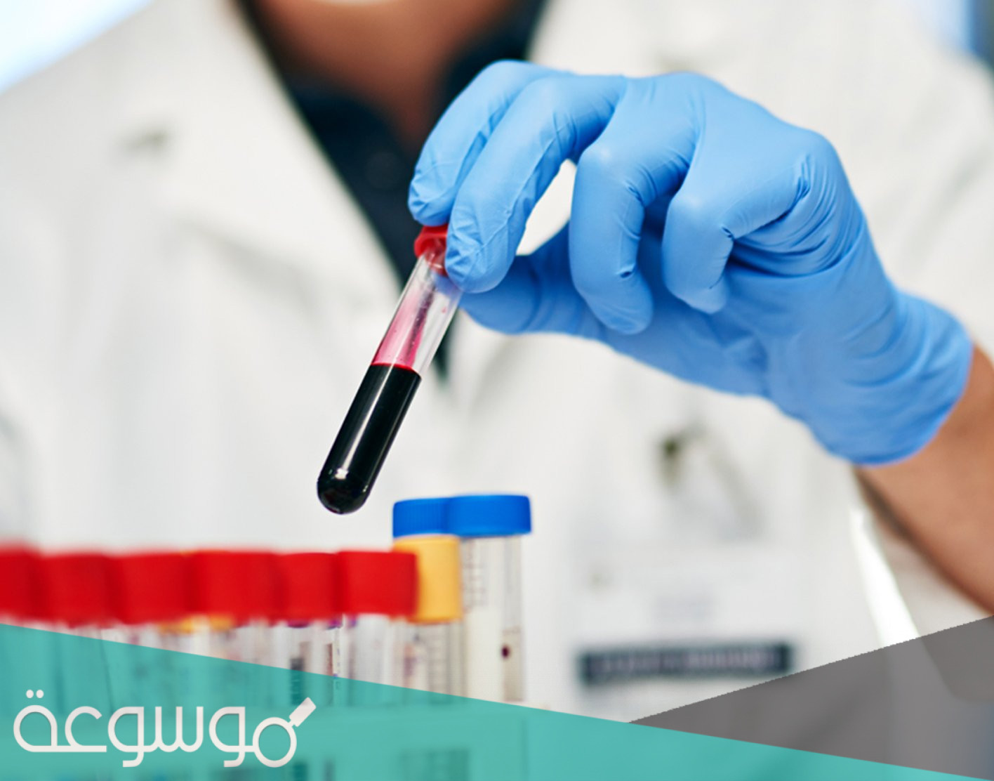 تحليل هرمون DHEA-S