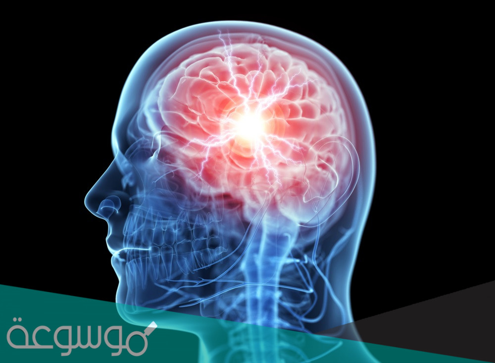 تطوير جهاز استشعار لعلاج السكتة الدماغية