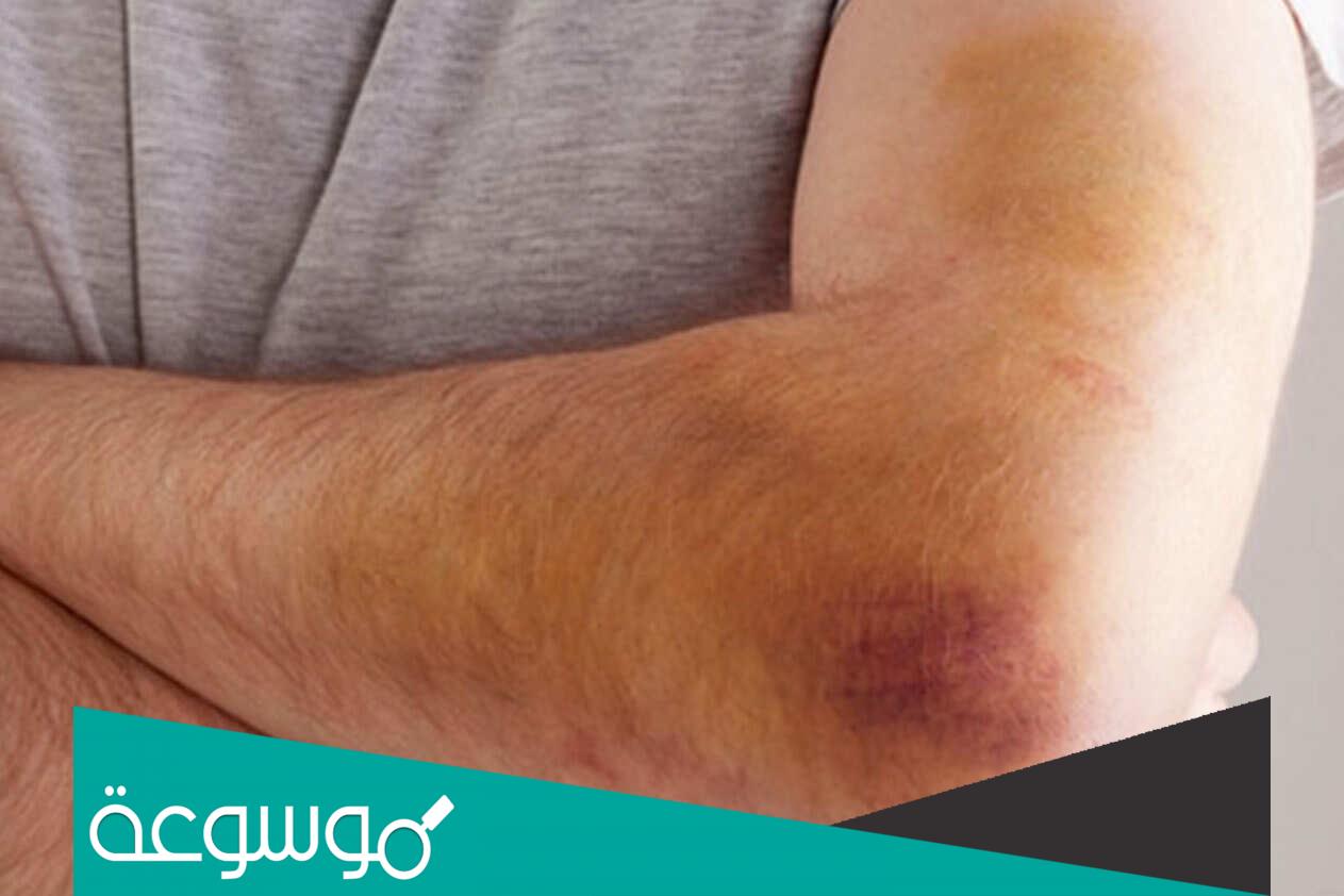 دواعي استخدام كريم hemoclar وسعره