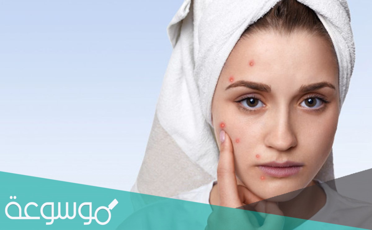 سبب ظهور حبوب في الوجه ايام التبويض وعلاجه مجرب