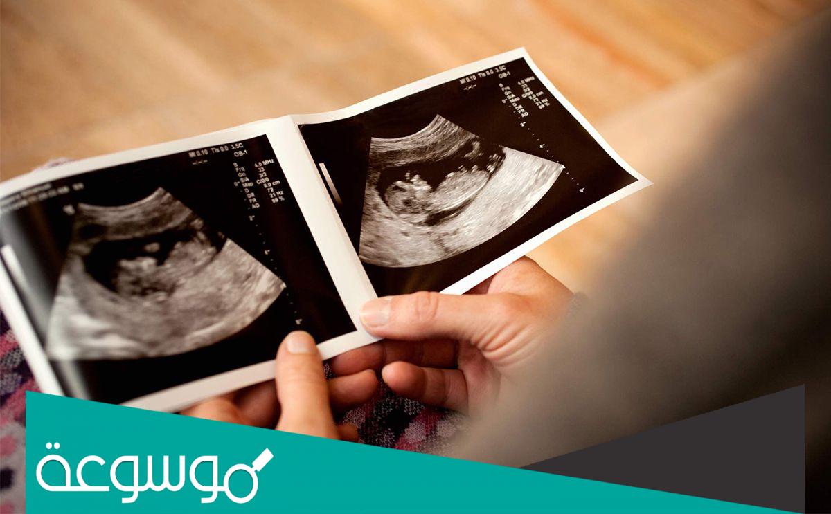 شرح ورقة السونار