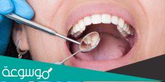 اسباب تسوس الاسنان رغم تنظيفها