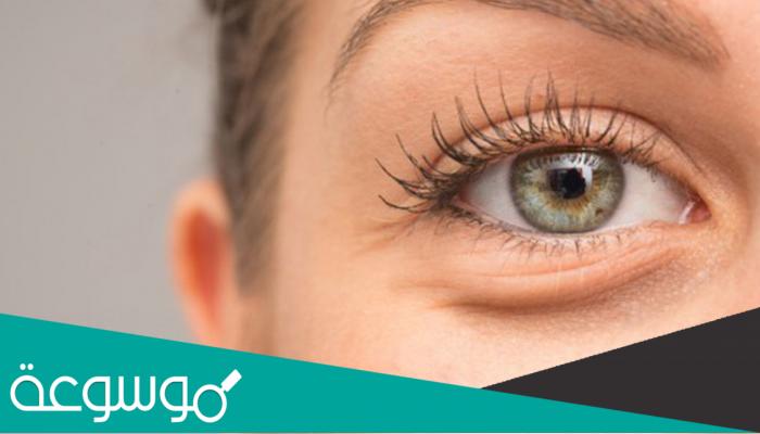 طرق التخلص من أكياس تحت العين