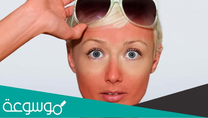 علاج احمرار الوجه من الشمس بالاعشاب