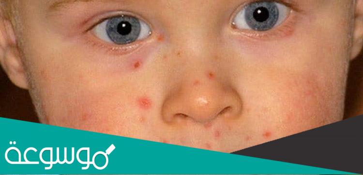 علاج الجدري المائي بالاعشاب