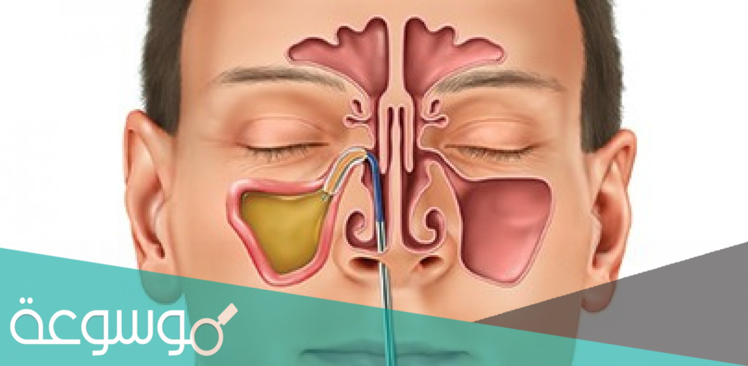 فلوكسيناز Flixonase لعلاج التهاب الجيوب الأنفية الموسمية وتأثيره