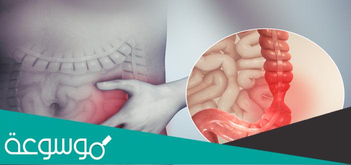 كيف أعرف فيني قولون عصبي ؟.. وهل الجوع يثيره