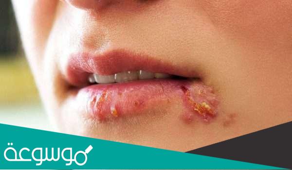 كيف ينتقل مرض الزهري وماهي مدة الشفاء وفترة العلاج اللازمة