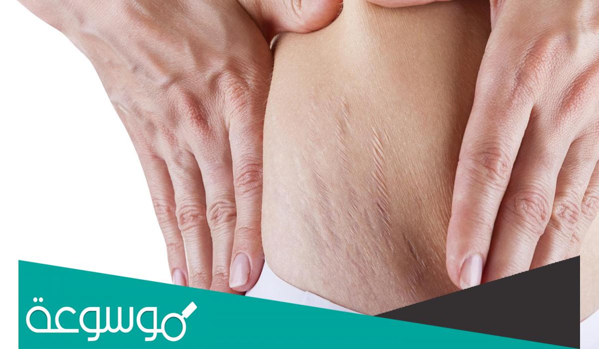 كيفية علاج تشققات الجسم الحمراء بالأعشاب والطب البديل والطرق الطبيعية