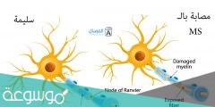 ما هو مرض ms وعلاجه
