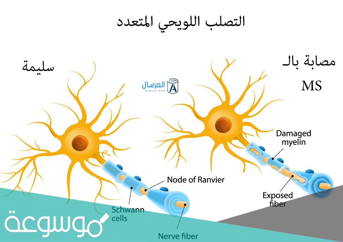 ما هو مرض ms وعلاجه