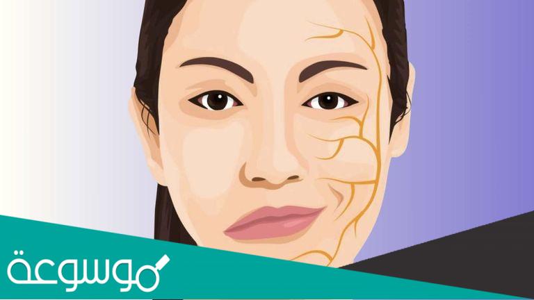 ما هو شلل بل ؟ شلل نصف الوجه المدعو “شلل ابو الوجيه”