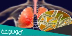 ما هو مرض الليجيونيرز وأعراضه وعلاجه