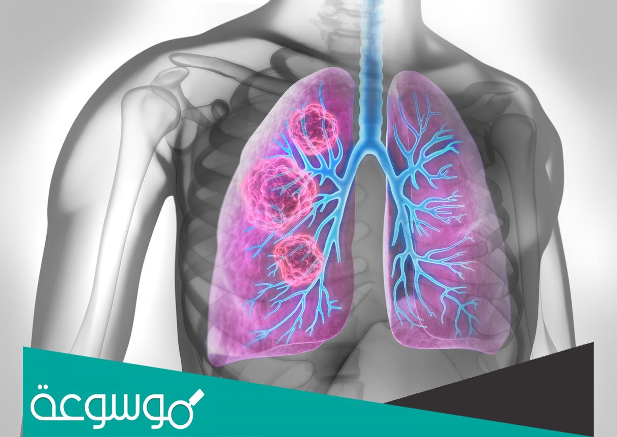 ما هي اعراض الغشاء البلوري واسبابه