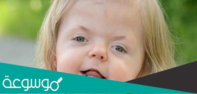 متلازمة أبيرت و أهم أعراضها و أسباب الإصابة بها