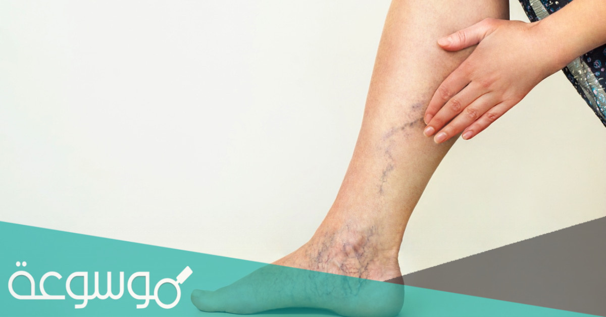 مخاطر مرض الاوعية الدموية المحيطية